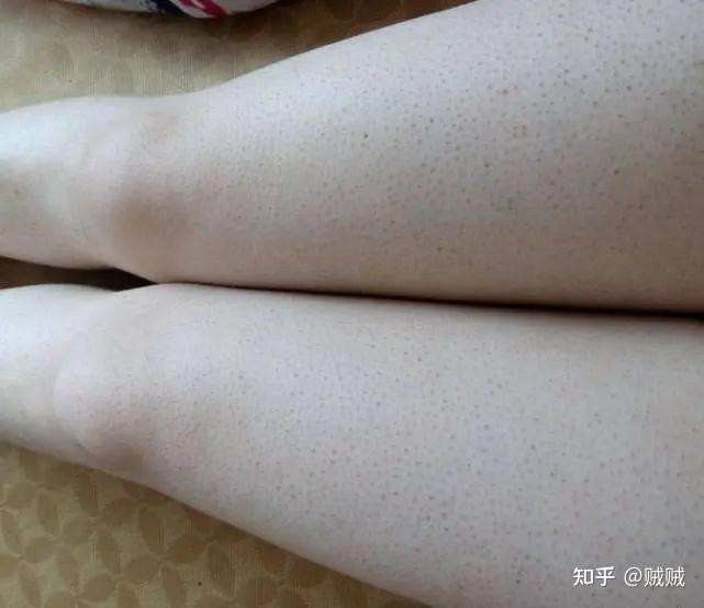 胖的就容易有鸡皮肤(为什么胖人容易鸡皮肤)