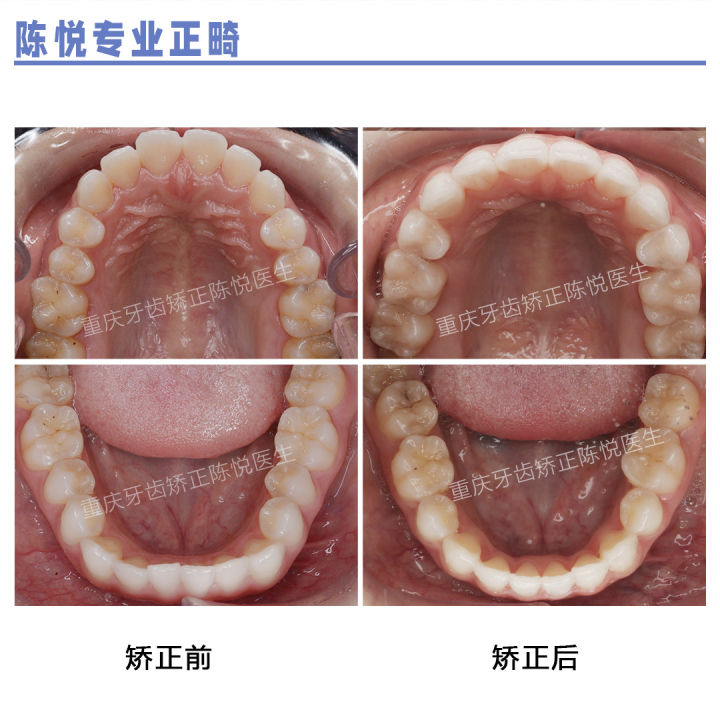 重庆牙齿矫正嘴突适度内收的个性化矫治方案