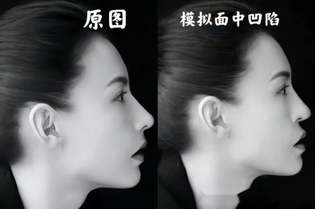 比嘴凸更可怕的是脸凹,刻薄显老,难怪大家更喜欢