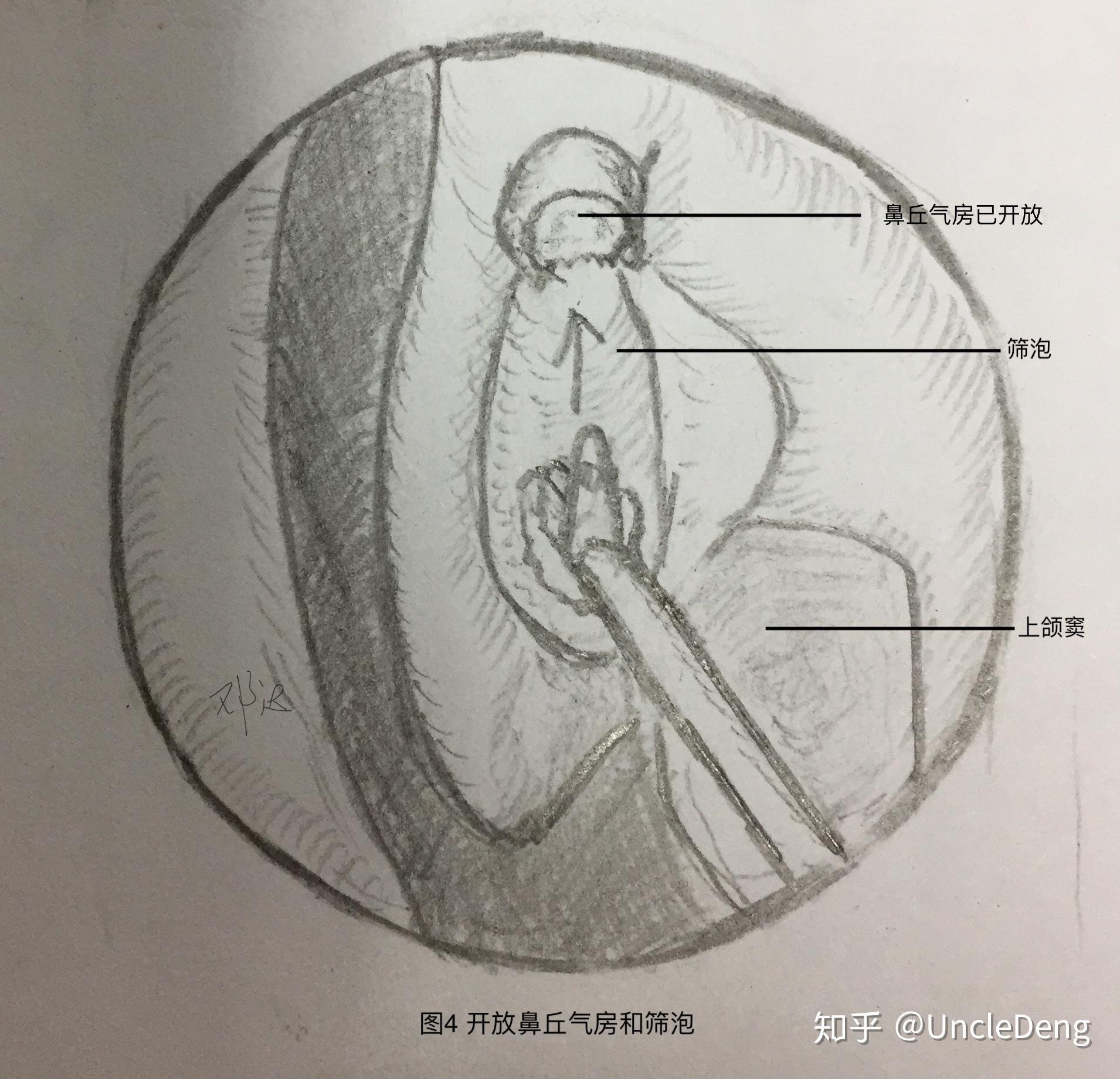 fess手术1例