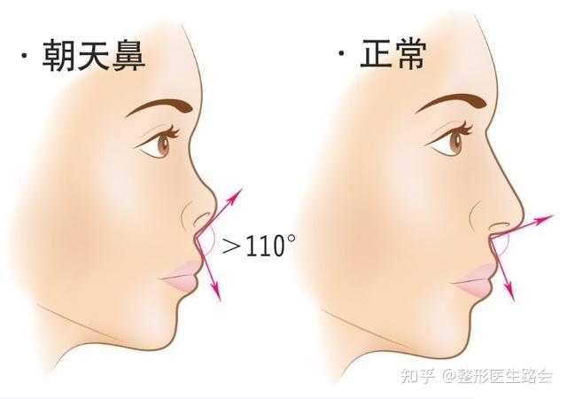 这5种鼻型，属于公认的“烦恼鼻”，看看你有没有中招？ - 知乎
