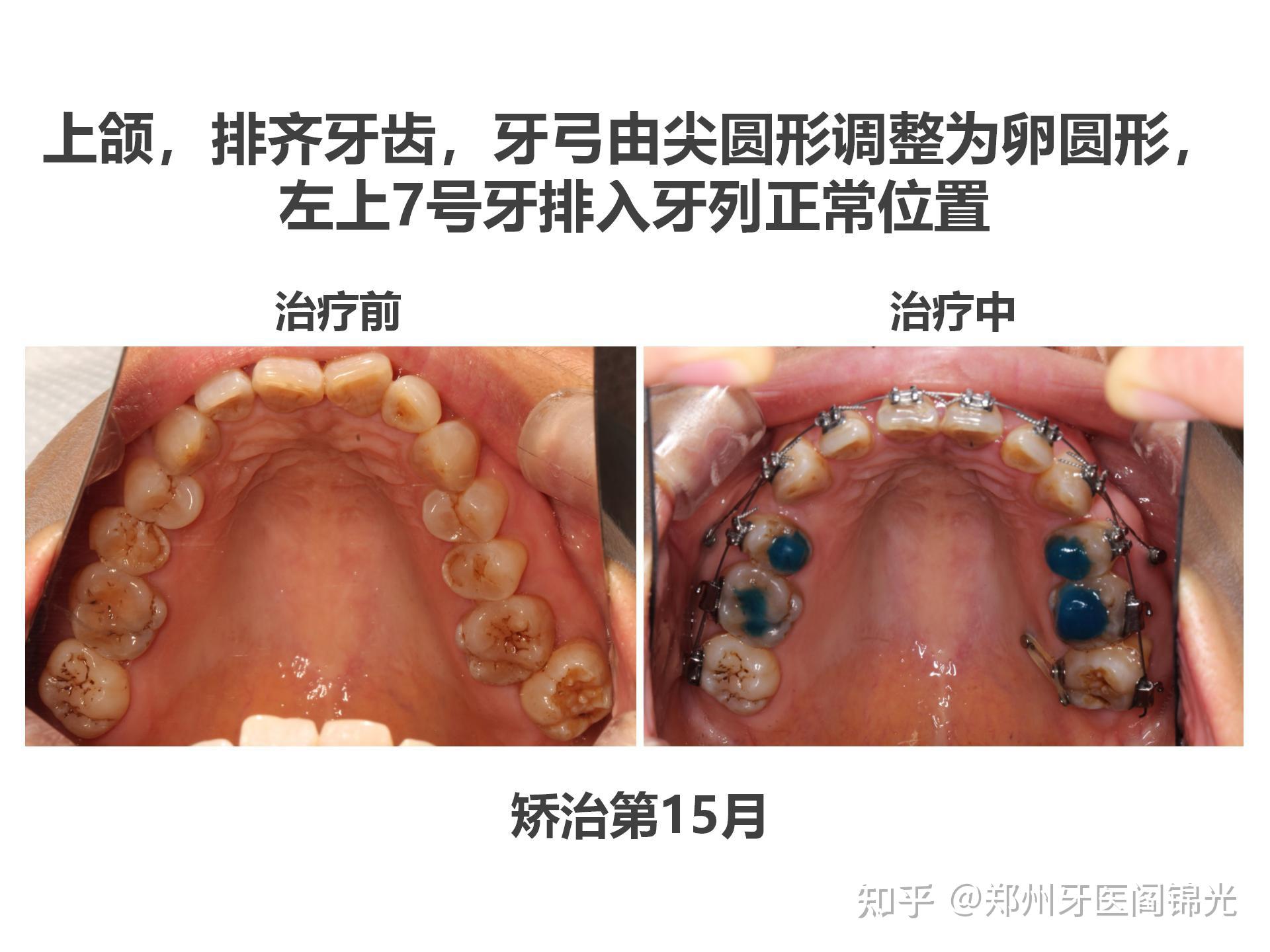 50岁,凸面形伴下颌发育不足,牙齿拥挤不齐,左侧后牙正锁合的固定矫治