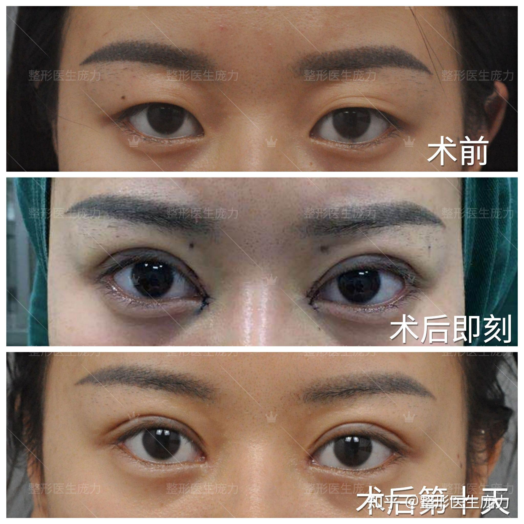 仿生态双眼皮开内眼角术后恢复过程