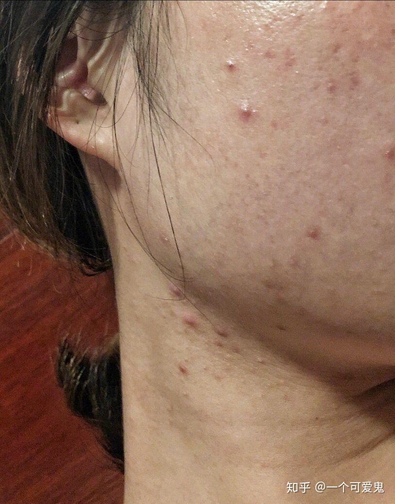 如何不长痘痘男生 v2-b2e41da1332923ebb24ed36f92f192a2_r.jpg