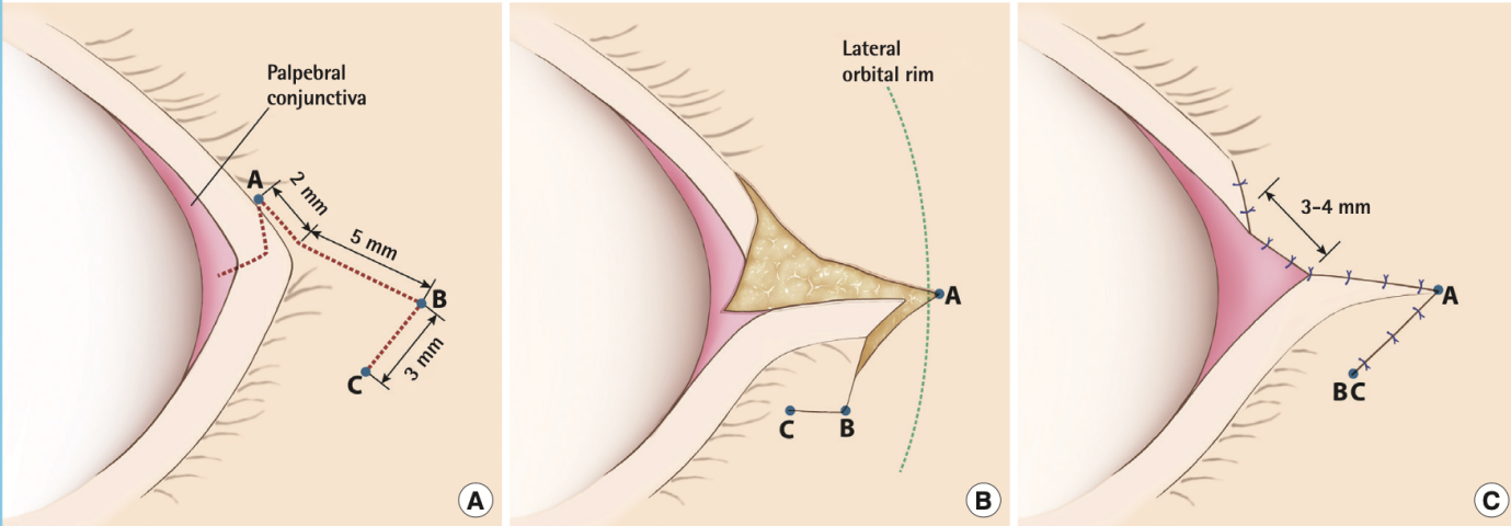 三,外眼角開大的主要手術方式