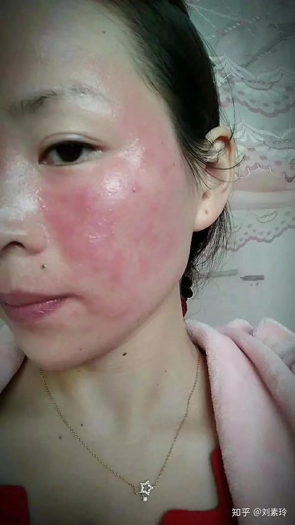 激素脸为什么去yi院都不管用激素脸还能zhi好么激素脸应该怎么办