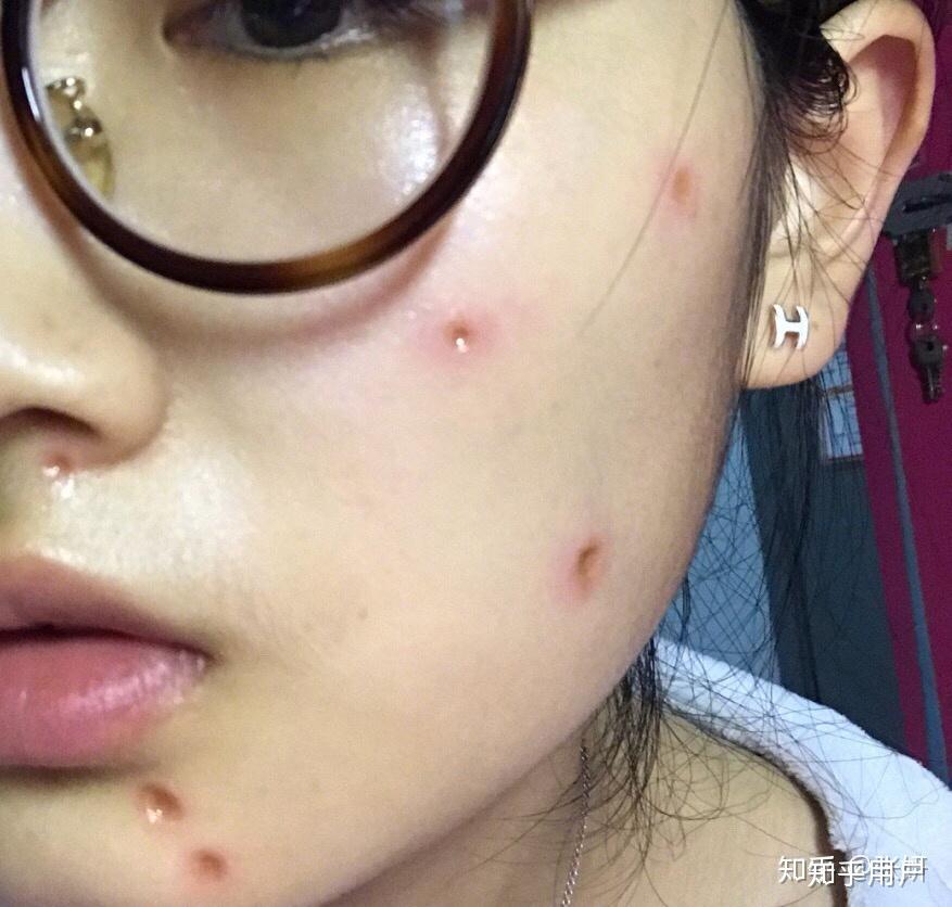 点痣成功与否会受季节影响吗?