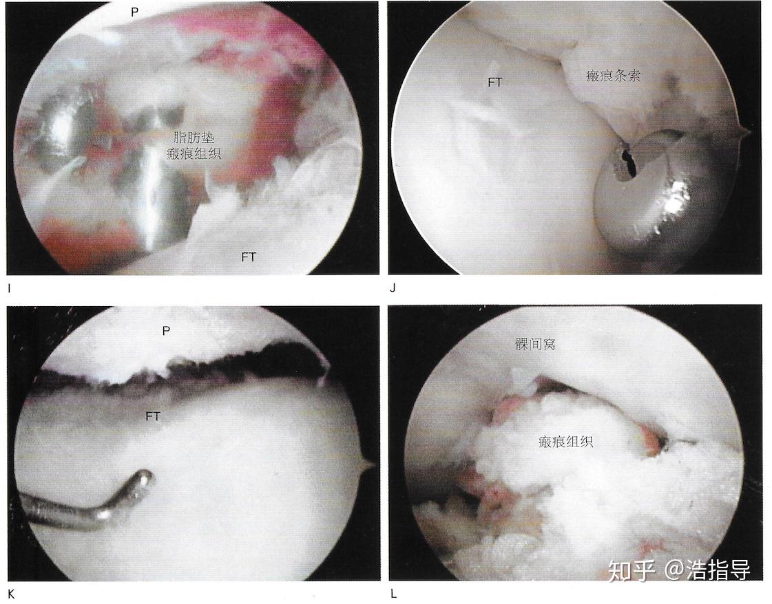 图解膝关节软组织挛缩粘连瘢痕