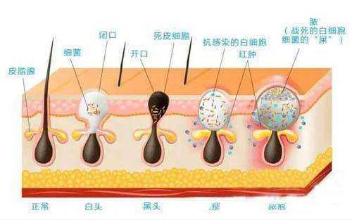 脸上长痘痘该怎么洗脸?