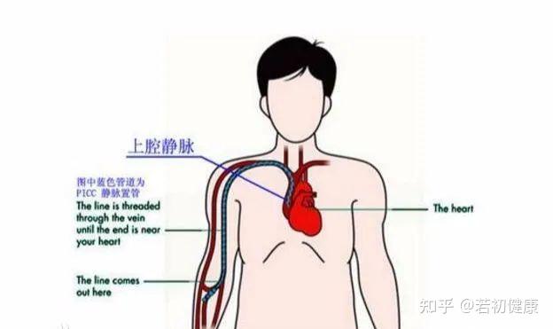 化疗 | PICC&PORT:一根通往心脏的管子 - 知乎