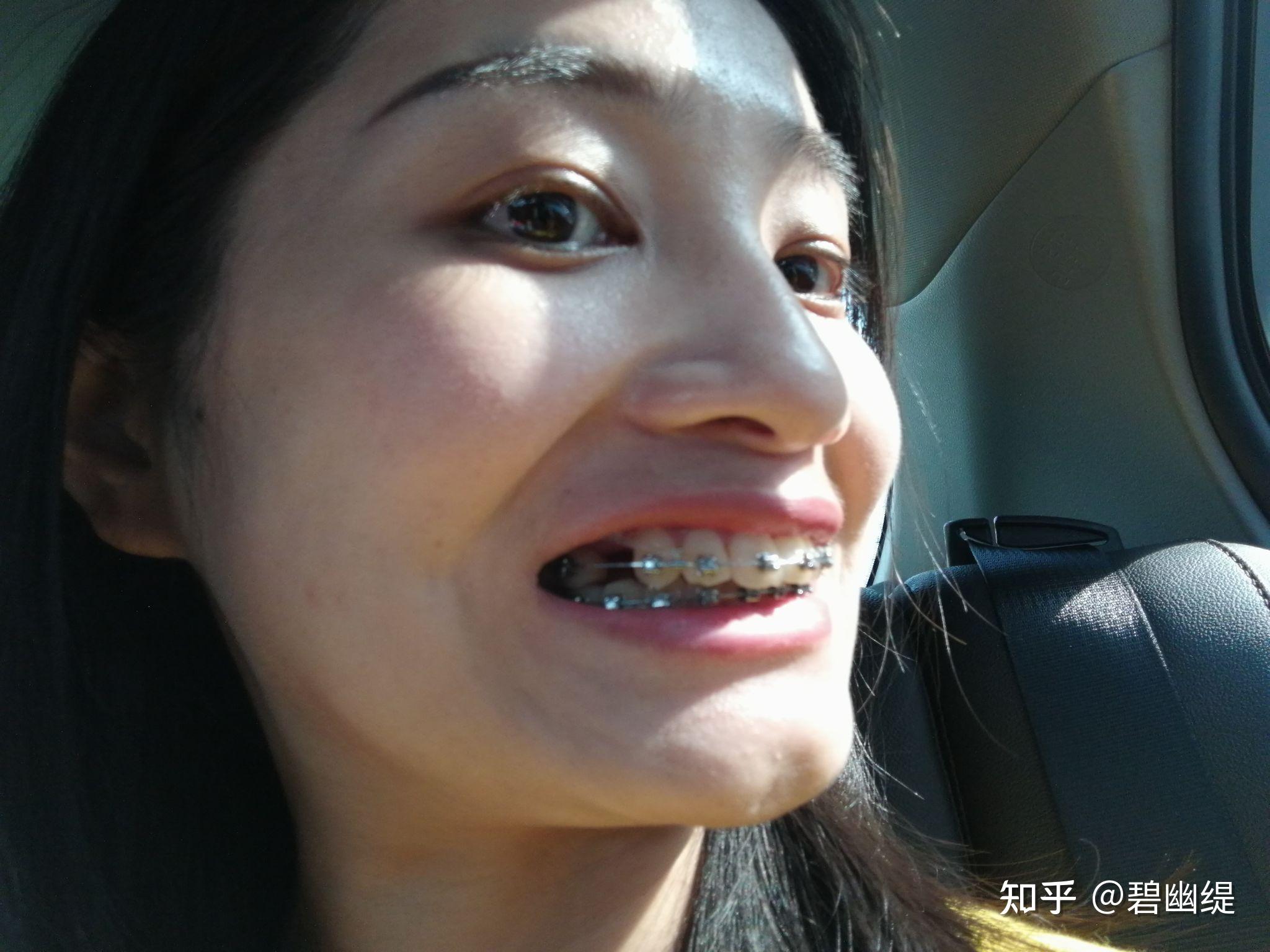 开帖记录30岁大龄女青年正畸过程龅牙前突深覆合和深覆盖严重