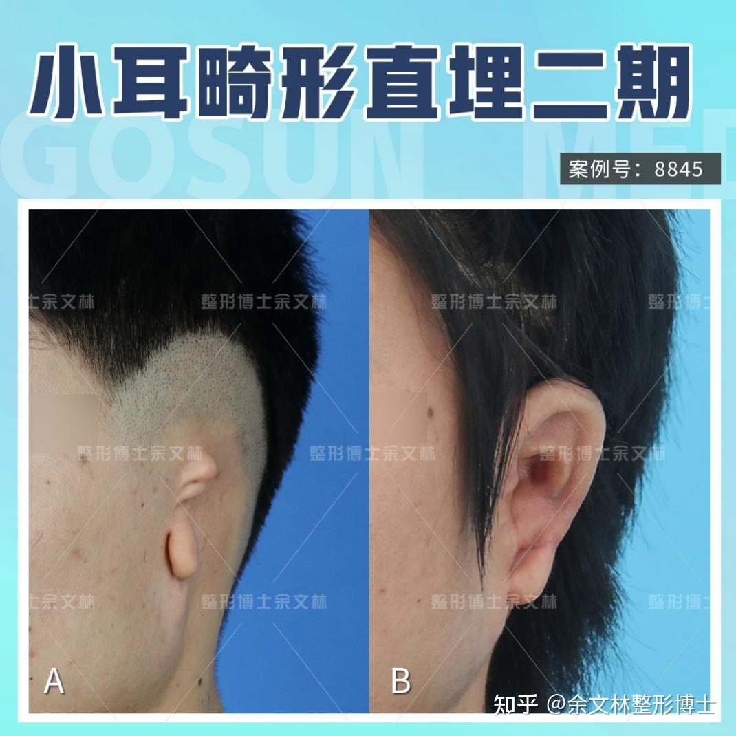 全国最好的耳朵畸形整形医院?小耳畸形术后恢复 - 知乎