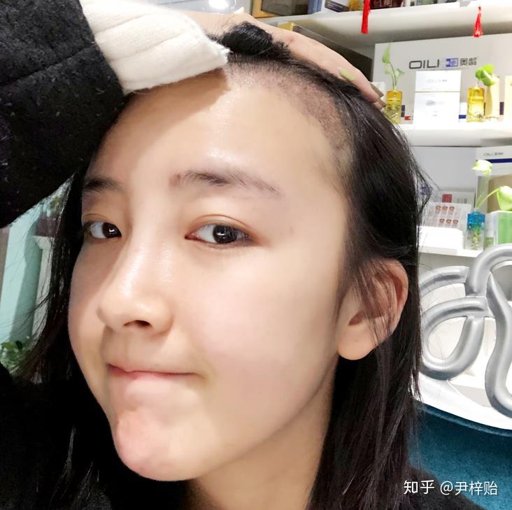 天生发际线高还有救吗?