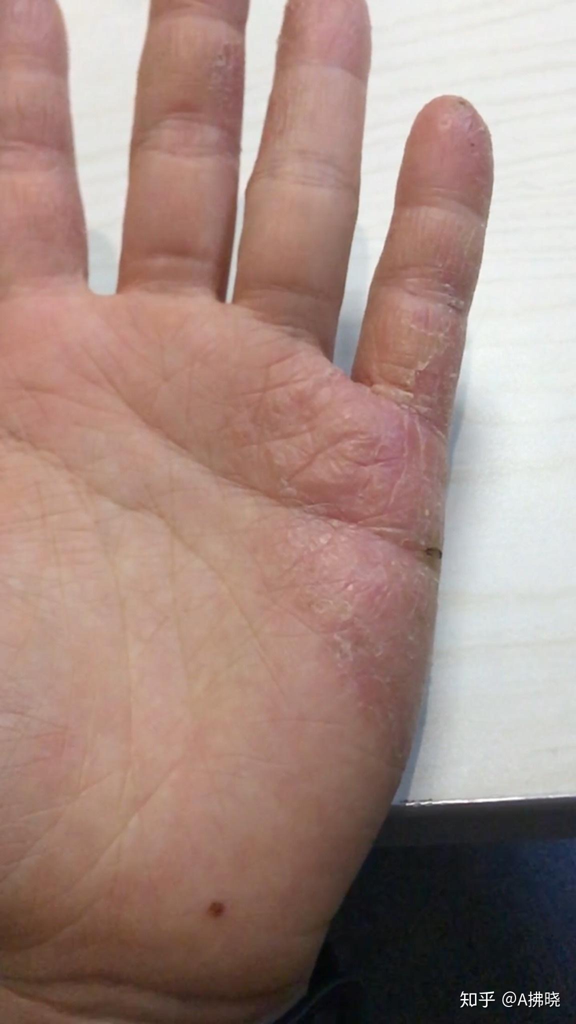 手指汗疱疹 治疗方法图片
