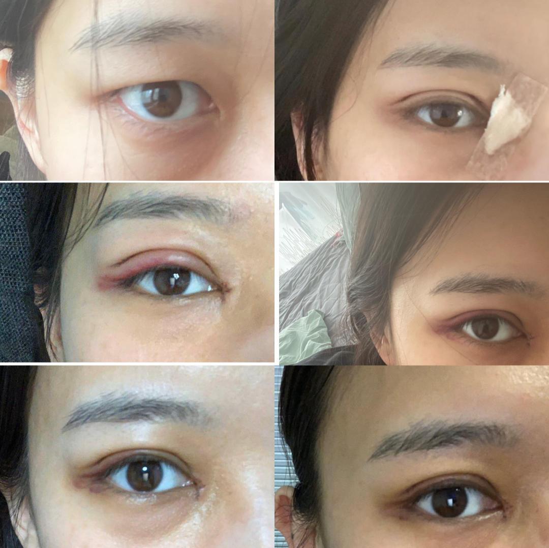 刘亦菲的开扇型双眼皮依然很受欢迎！ 目前双眼皮形状_圈子-新氧美容整形