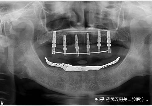 牙醫一直讓你拍的口腔全景片到底有什麼用