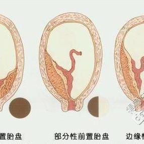 胎盘低置