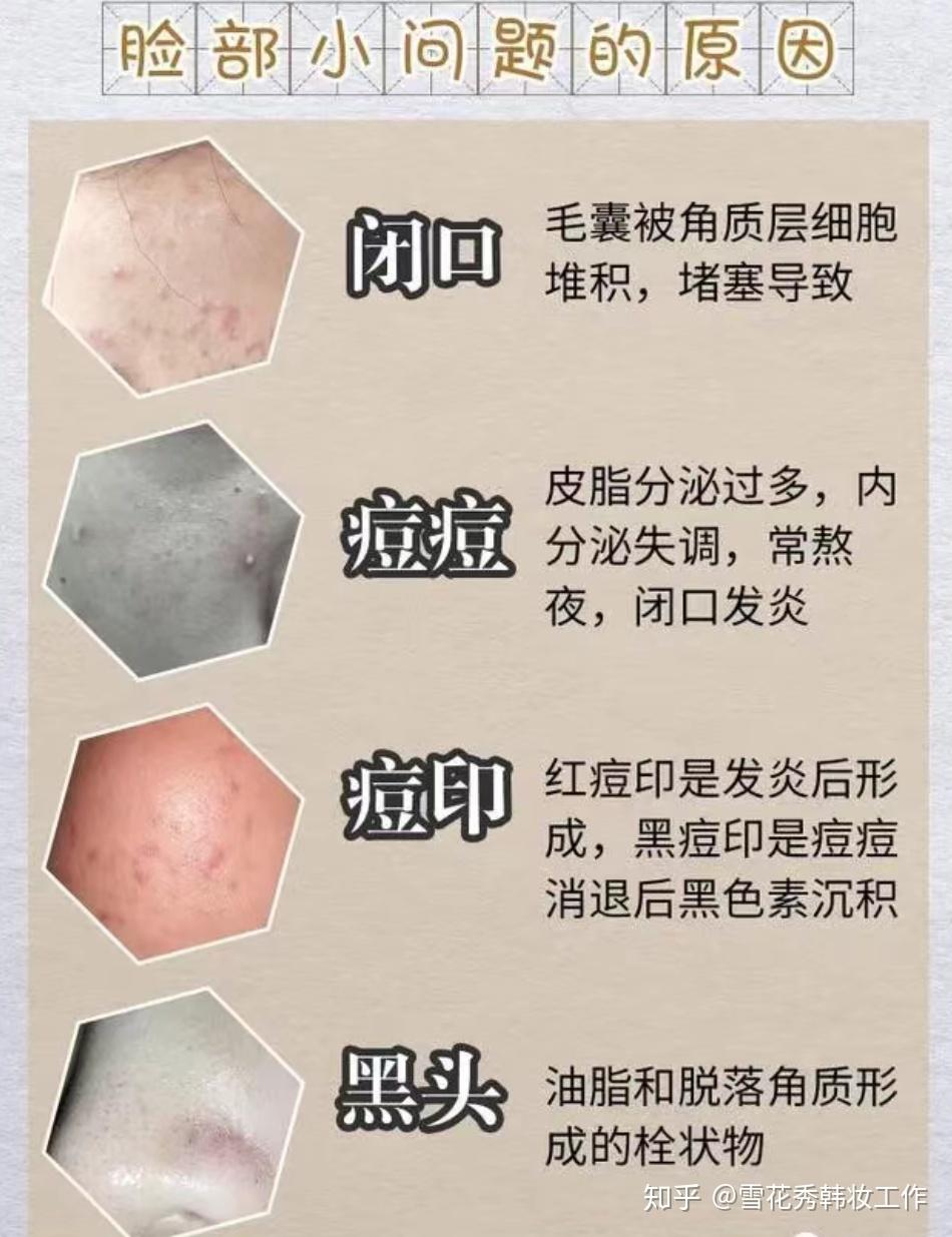红痘印是发炎后形成,黑痘印是痘痘消退后黑色素沉积痘痘:皮脂分泌过多
