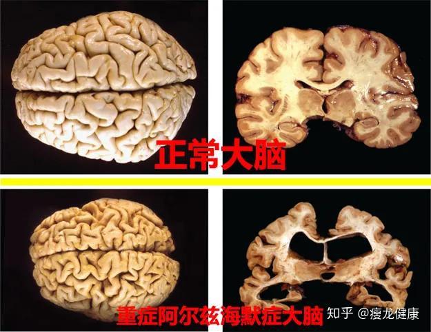 老年痴呆的大脑和正常人的到底有什么区别呢?怎么就变痴呆了呢?