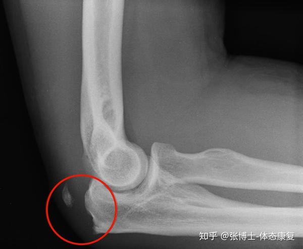 运动康复科普 肘关节损伤的常见类型与急性处理方法 知乎