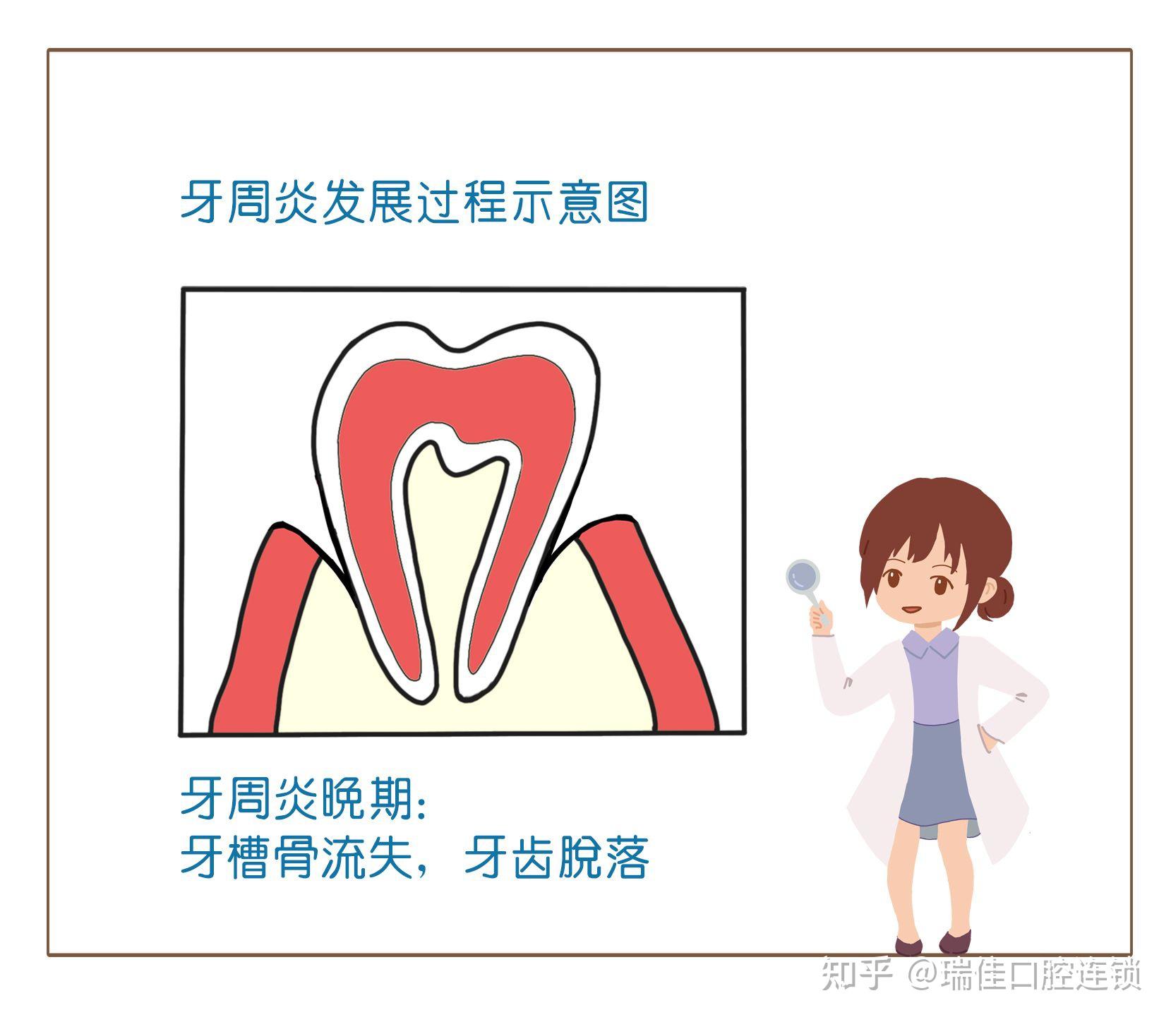 牙周炎發展過程示意【牙周炎的患者常見症狀有牙齦紅腫牙齦出血,牙齦