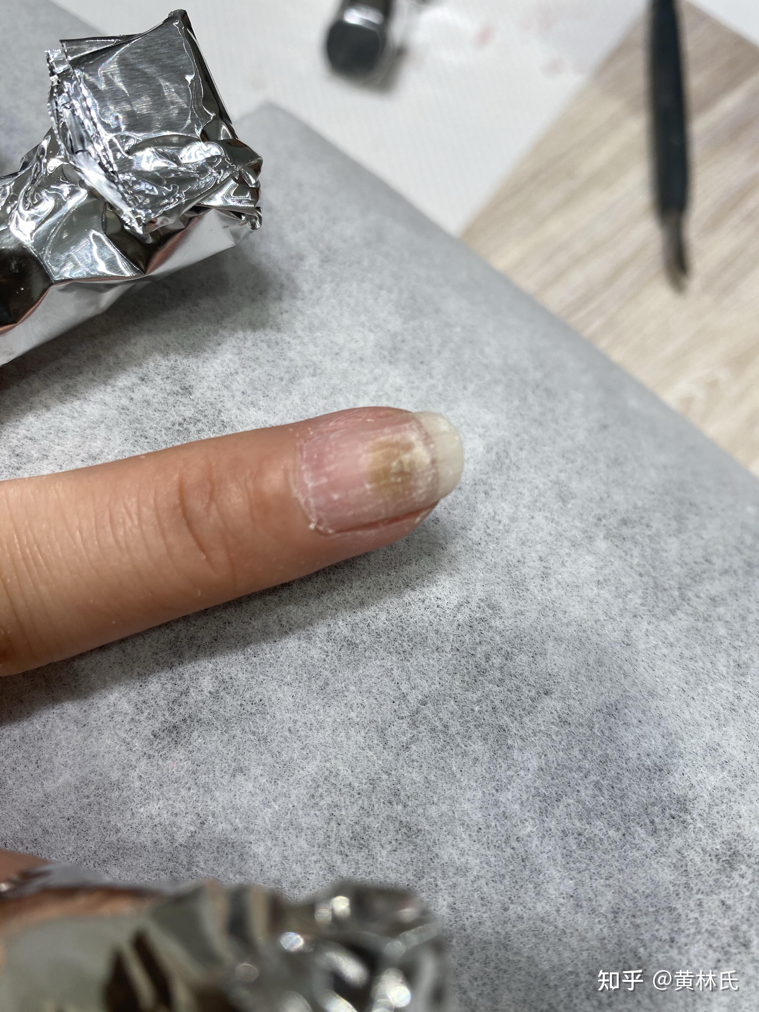 贴了甲片然后2周以后卸了就指甲就变绿了是怎么回事