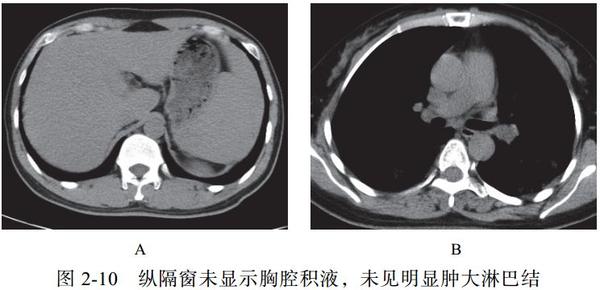 新冠肺炎ct早期征象与鉴别诊断 知乎 5540