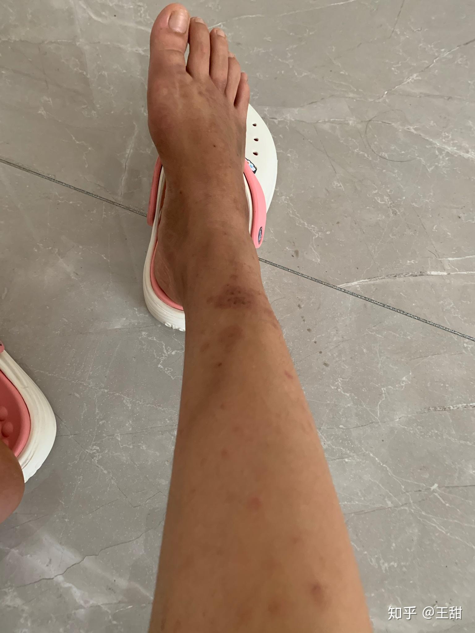 想说说关于脂膜炎伴血管炎的这么一个病! - 知乎