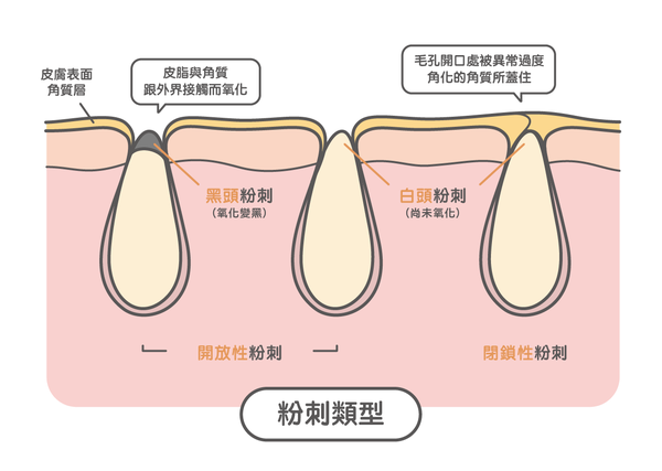 什么是闭合型粉刺?如何处理? - 知乎