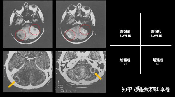 磁共振增强扫描的临床应用 - 知乎