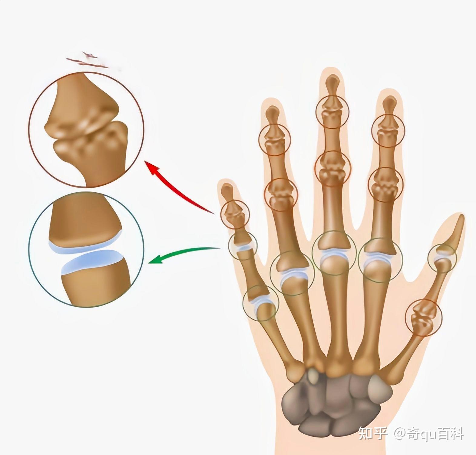 原来这种咔咔声其实并不是骨头骨头摩擦所发出来的