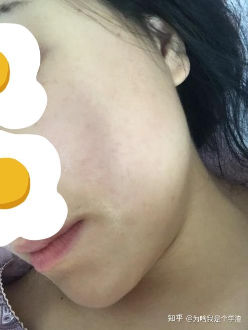 下巴反复长闭口,一大排密密麻麻还凸起怎么办?