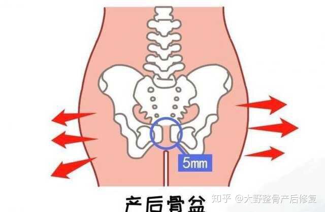 而懷孕後,由於其內分泌改變,使恥骨聯合周圍韌帶鬆弛,這時若遇輕微