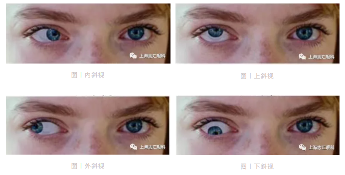 一般小于2岁,持续时间长并且恒定;单眼斜易发生,程度较重;交替性斜视