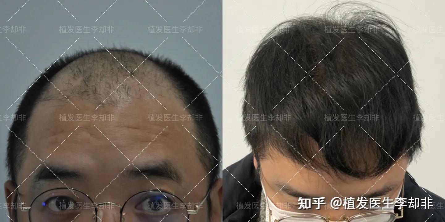 植发效果能维持多久？植发医生的真实植发感受，给你最实用的植发建议！ - 知乎