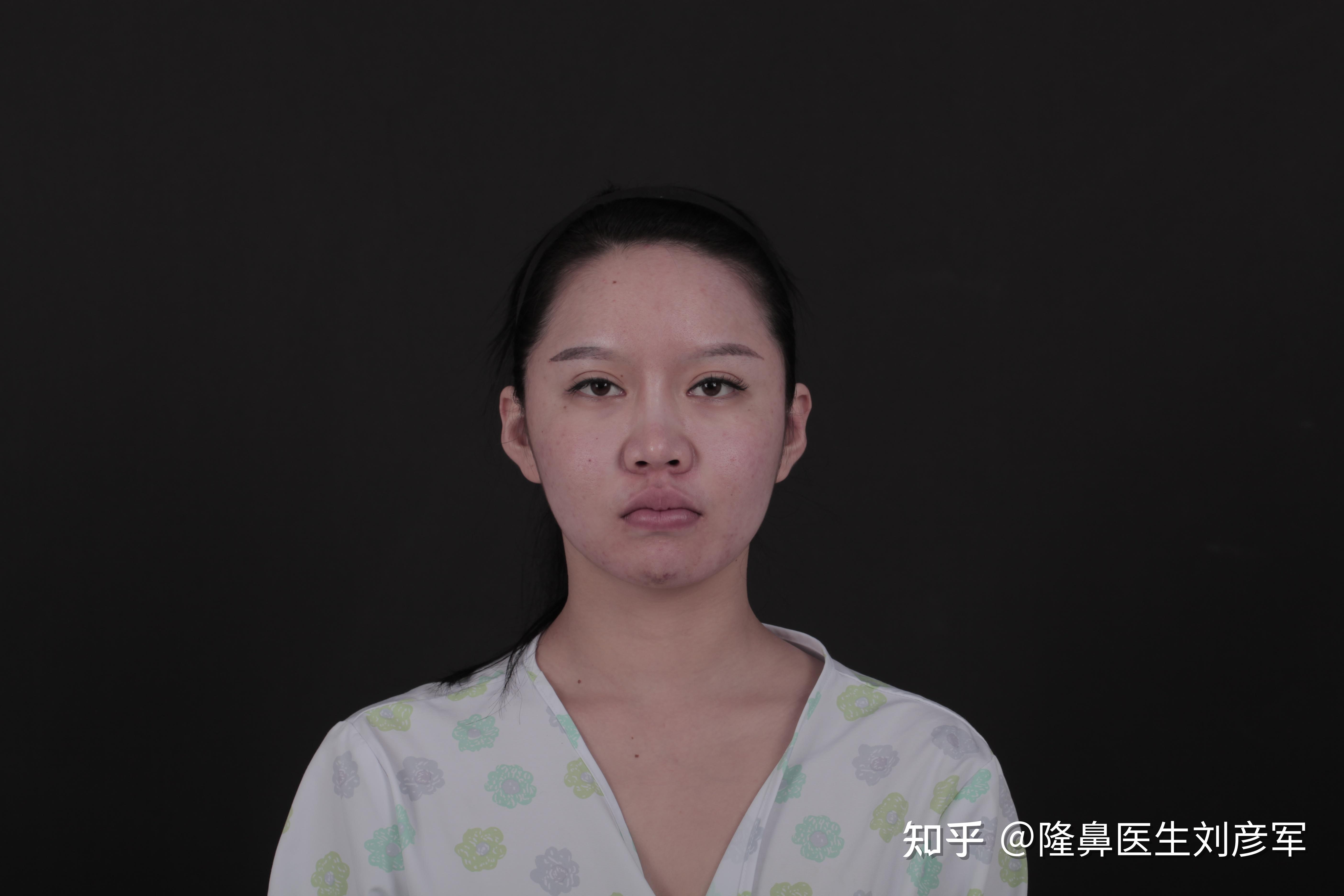 做隆鼻手术要好多钱_隆鼻手术贵吗_隆鼻手术多少钱