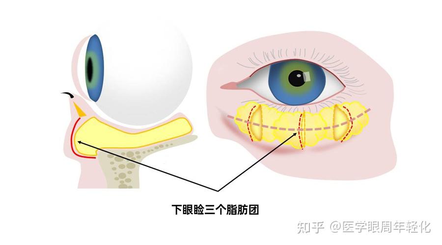 祛眼袋可以做眶隔脂肪释放术吗