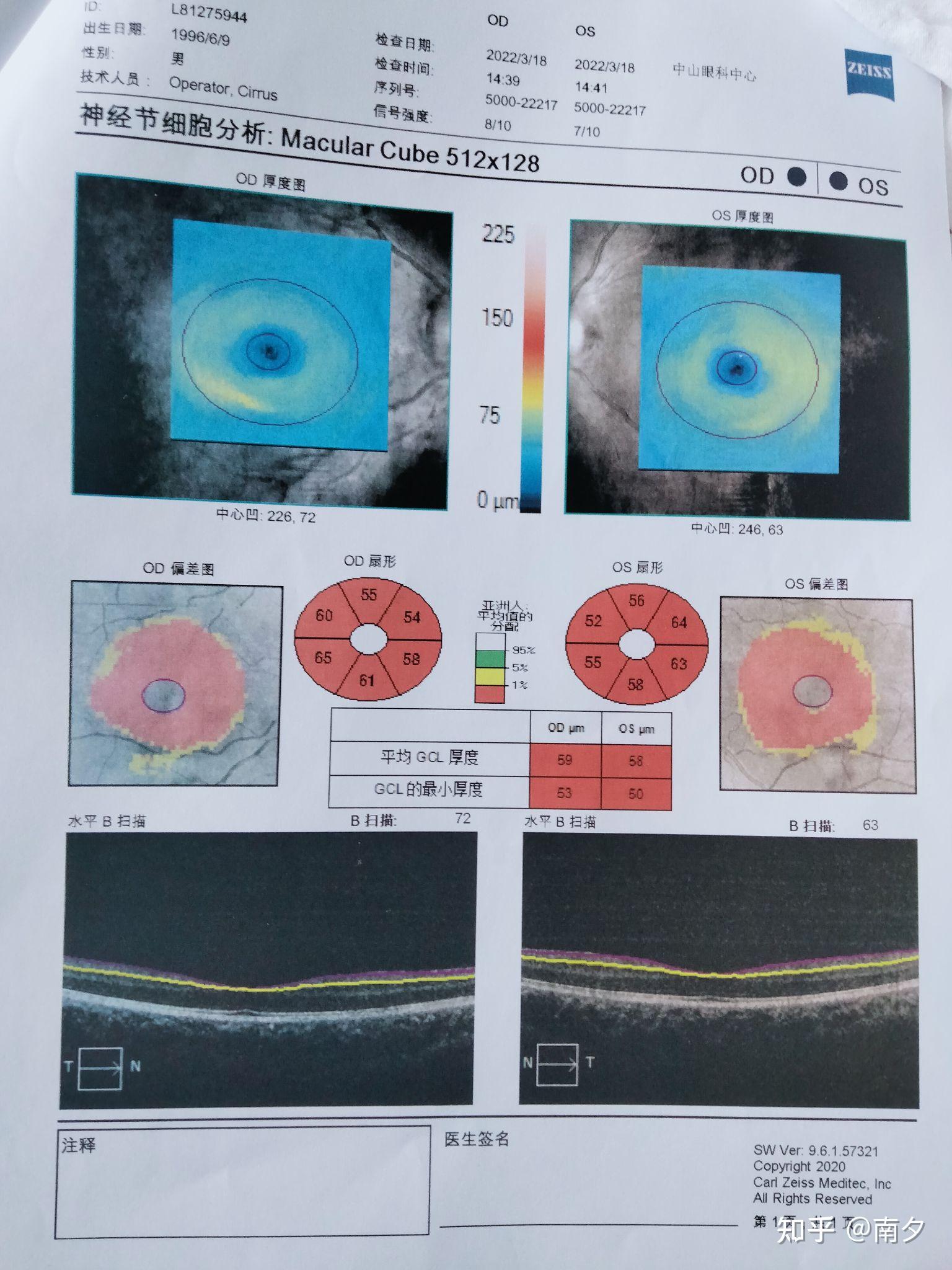 视神经萎缩,个人经历 - 知乎