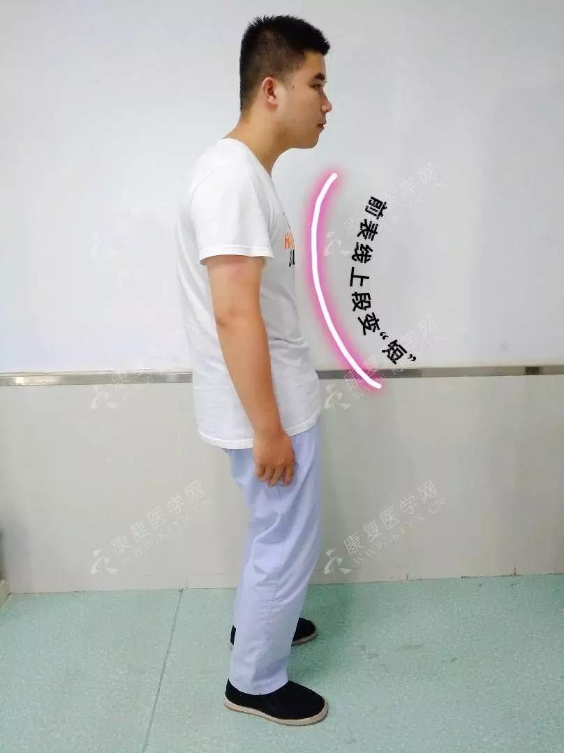 如何通过姿势评估前表线和筋膜问题？（附手法治疗） - 知乎