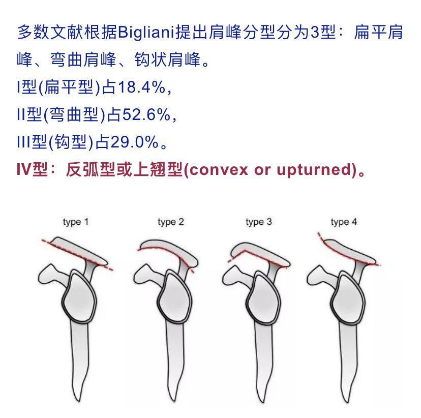 6%,Ⅲ型(钩型)占29.0%,Ⅳ型(反弧形或上翘型)数量极少,可以忽略不计.