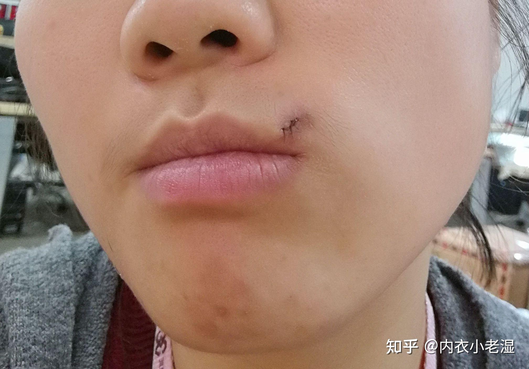 嘴角媒婆痣大毛痣切除两年后