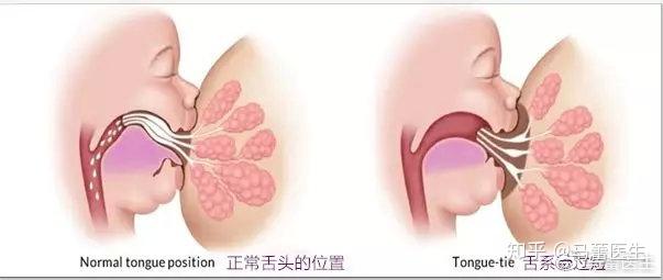  舌系帶剪斷的利弊_舌系帶剪斷的利弊有哪些