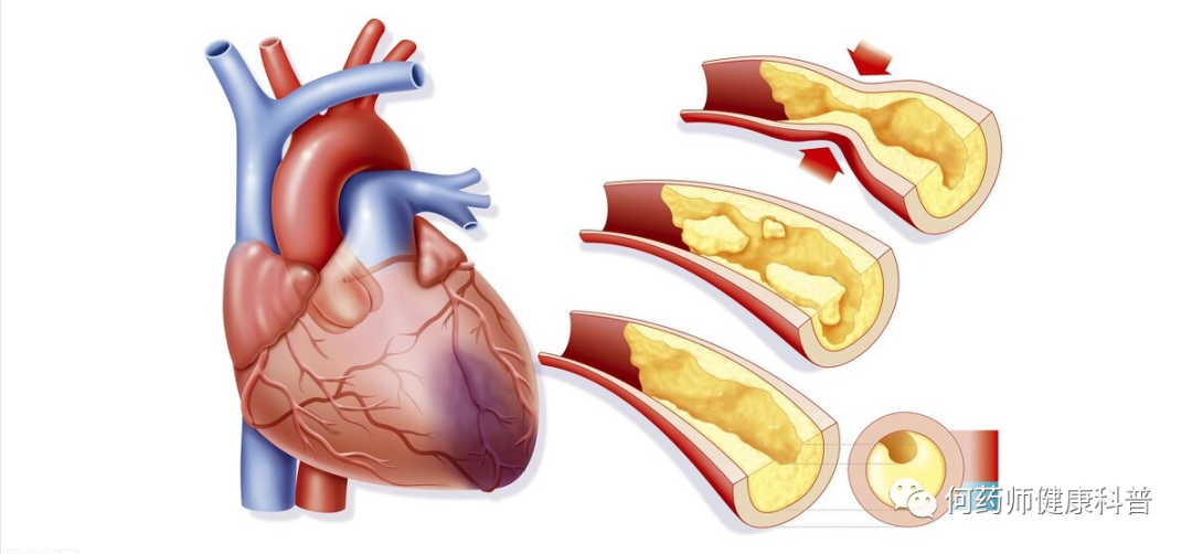 养心氏片从6方面改善冠心病心绞痛心衰心梗促进心脏康复