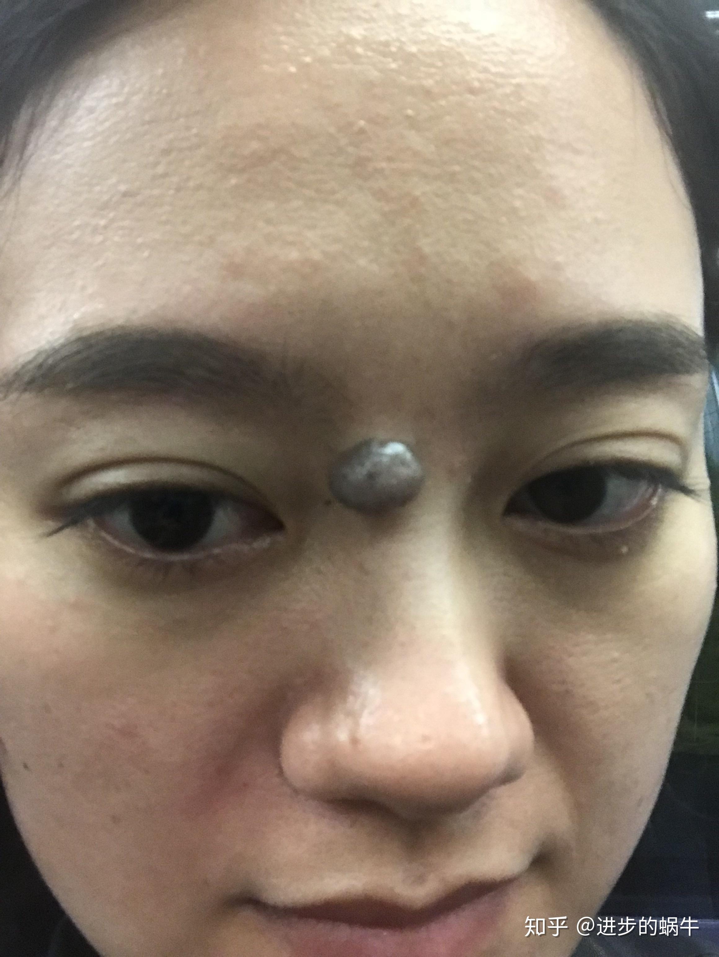 上海九院手术切痣经历