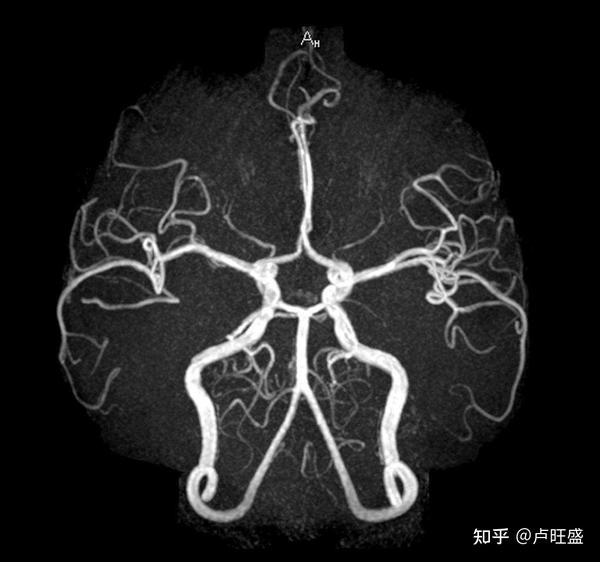 头颅磁共振血管成像体检，为何要做？ - 知乎