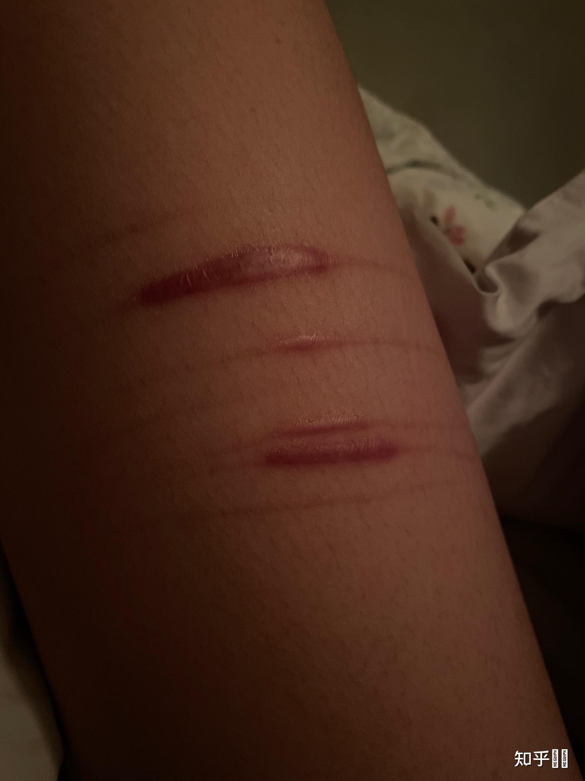 割腕的疤可以去掉吗