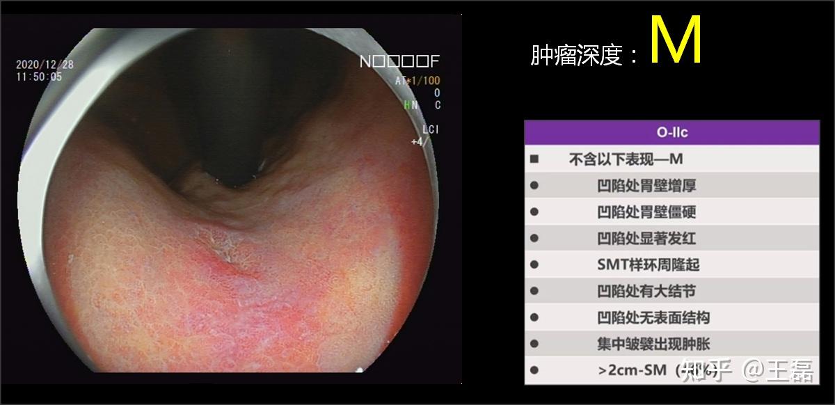 食管下段贲门癌图片图片