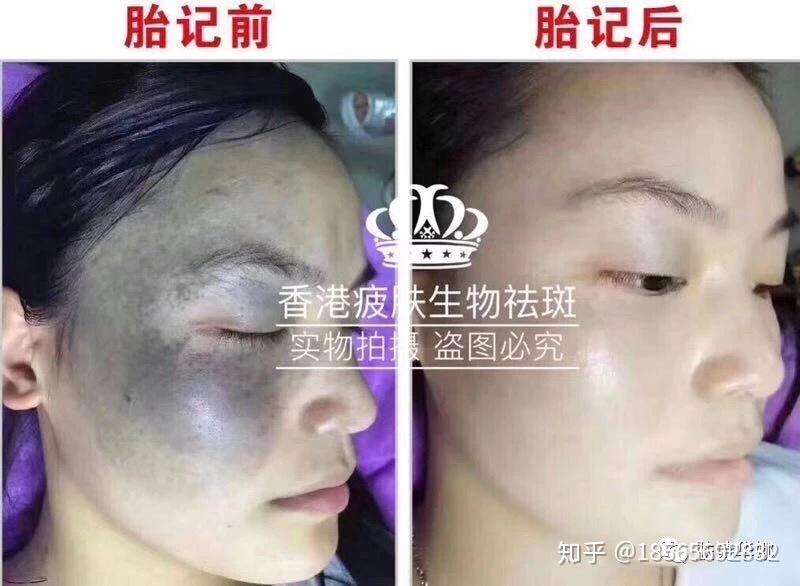 胎记案例 - 知乎