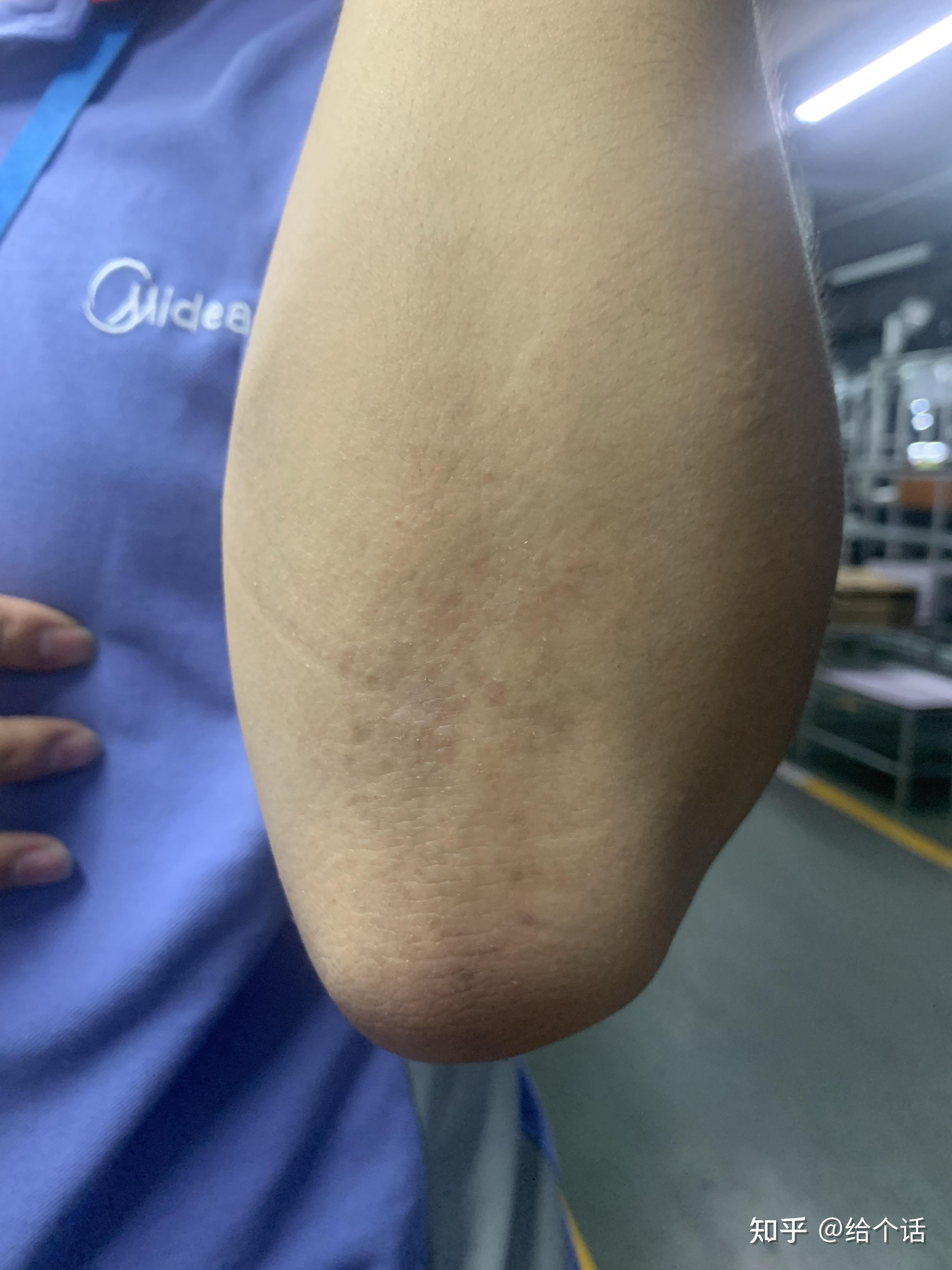 手臂表皮发痒发黑这是咋了不会得什么大病了吧