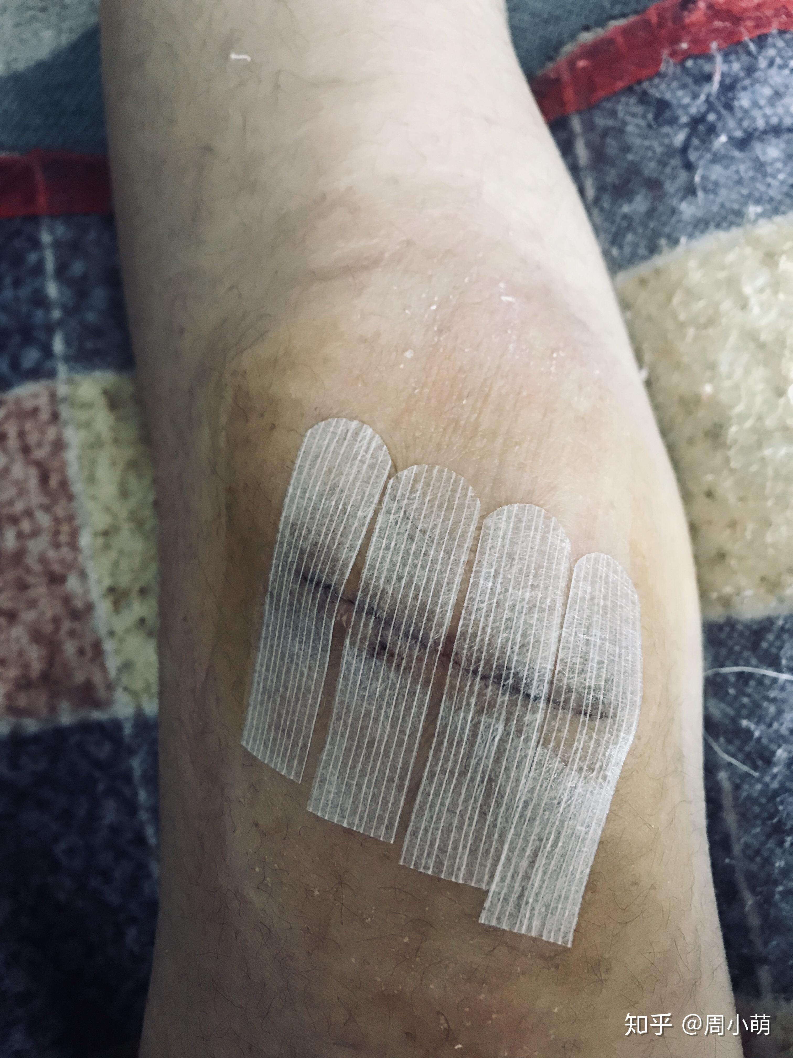 膝盖疤痕增生手术之第三篇